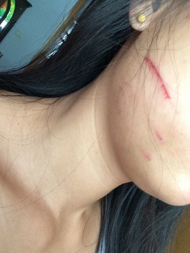 一般女子打架,当留下伤痕,经常是这样的,挠的